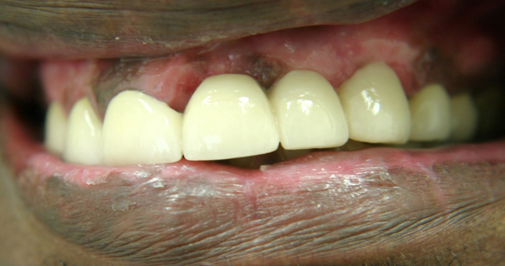 Broken Bridge and Missing Teeth Repaired With New Bridge 1 After 1