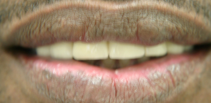 Broken Bridge and Missing Teeth Repaired With New Bridge 1 After 2