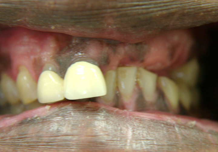 Broken Bridge and Missing Teeth Repaired With New Bridge 1 Before