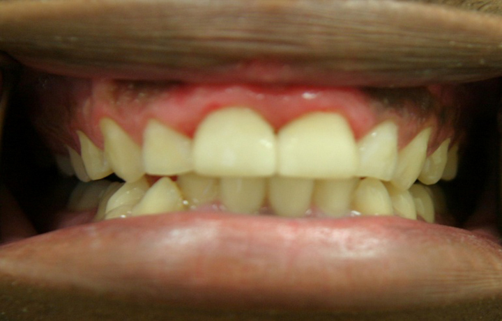 Broken Stained Front Teeth Repaired With All Ceramic Crowns 1 After 1