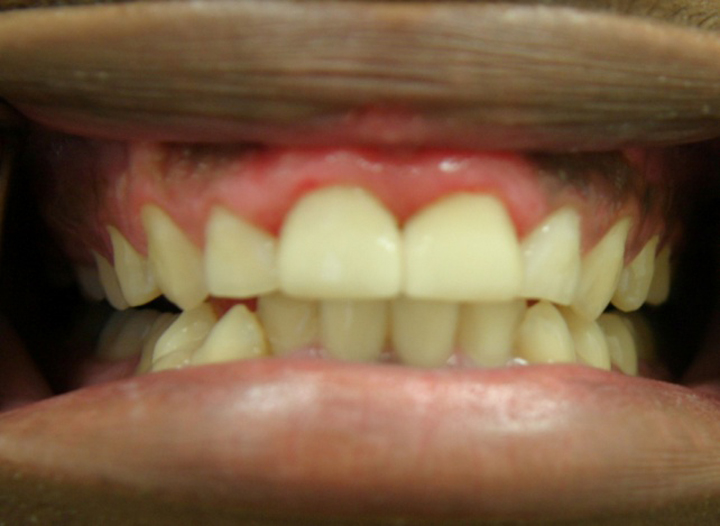 Broken Stained Front Teeth Repaired With All Ceramic Crowns 1 After 2