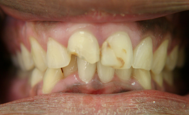 Broken Stained Front Teeth Repaired With All Ceramic Crowns 1 Before