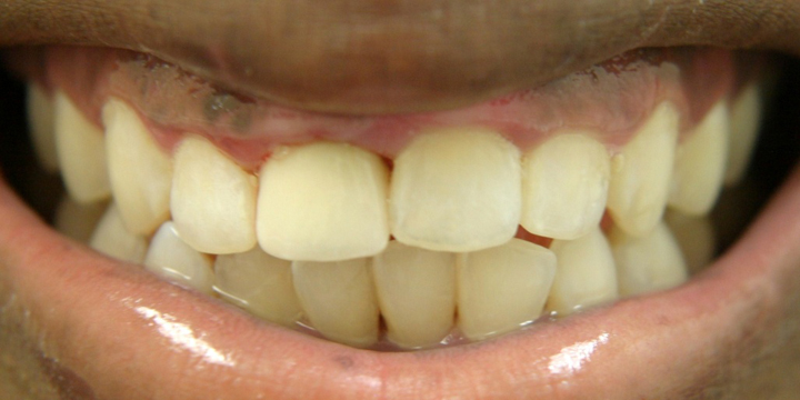 Broken Tooth Repaired With A Crown 1 After
