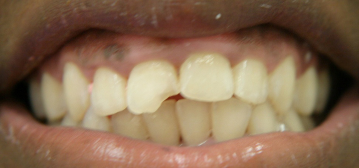 Broken Tooth Repaired With A Crown 1 Before 1