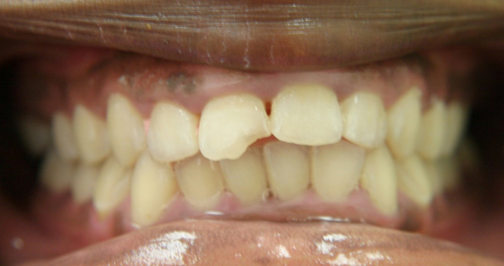 Broken Tooth Repaired With A Crown 1 Before 2