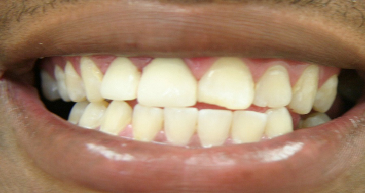 Decayed and Fractured Teeth Repaired With Crowns 1 After 1