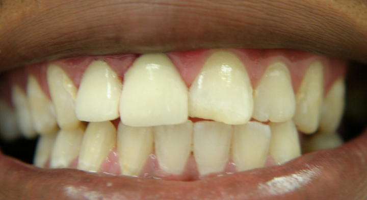 Decayed and Fractured Teeth Repaired With Crowns 1 After 2