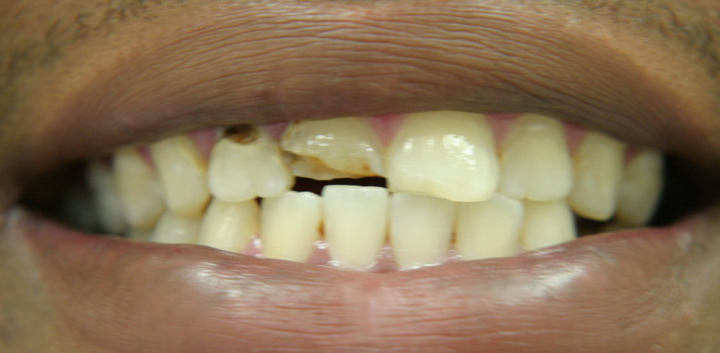 Decayed and Fractured Teeth Repaired With Crowns 1 Before 1