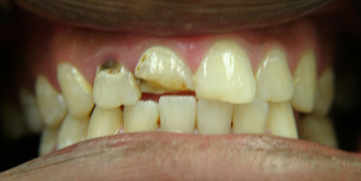 Decayed and Fractured Teeth Repaired With Crowns 1 Before 2