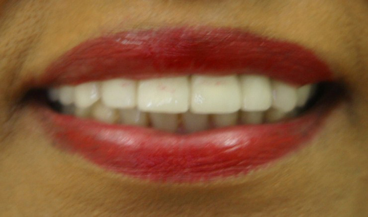 Extreme Smile Makeover with Bridges 1 After 1