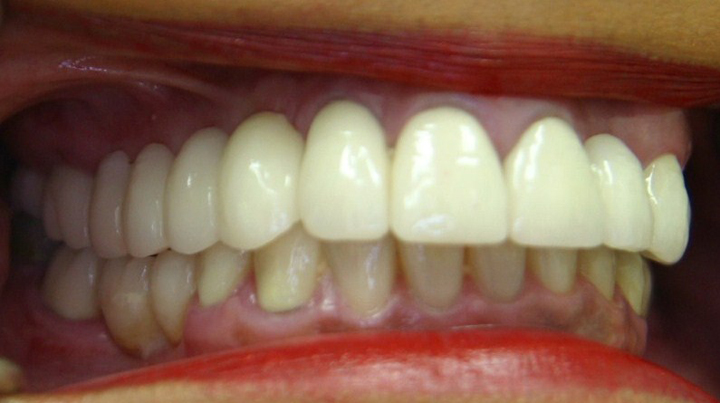 Extreme Smile Makeover with Bridges 1 After 2