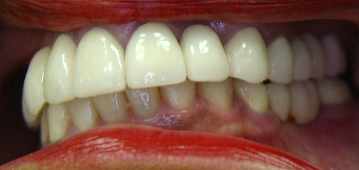 Extreme Smile Makeover with Bridges 1 After 3