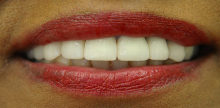 Extreme Smile Makeover with Bridges 1 After 4