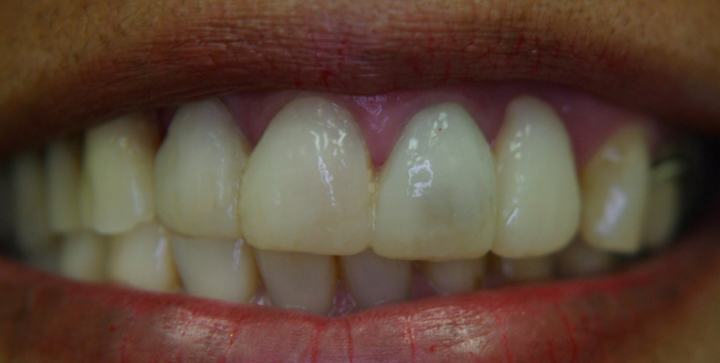 Extreme Smile Makeover with Bridges 1 Before 1