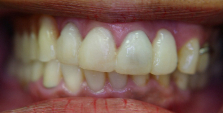Extreme Smile Makeover with Bridges 1 Before 2