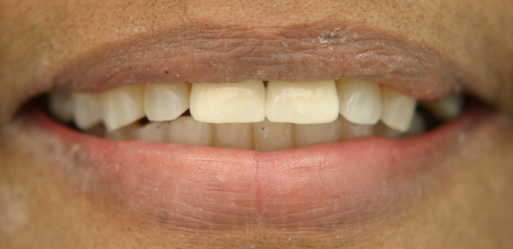 Fractured Front Teeth Repaired With Crowns 1 After 1