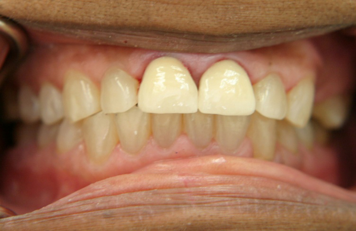 Fractured Front Teeth Repaired With Crowns 1 After 2