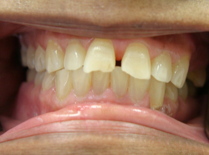 Fractured Front Teeth Repaired With Crowns 1 Before
