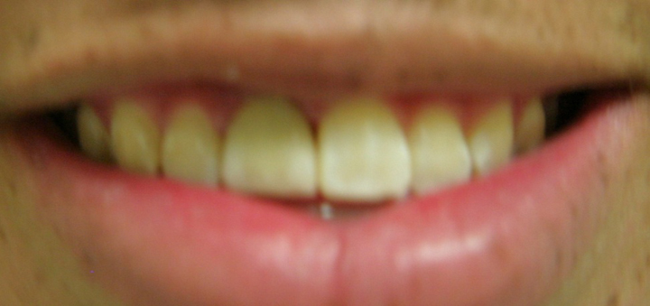 Fractured Tooth Repaired With A Crown 1 After 1