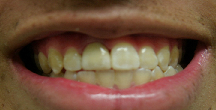 Fractured Tooth Repaired With A Crown 1 After 2