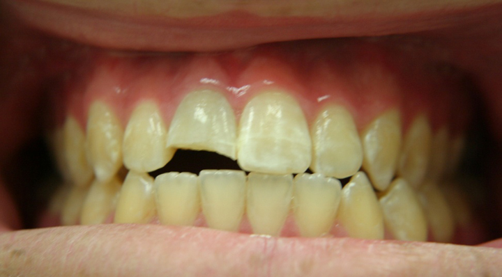 Fractured Tooth Repaired With A Crown 1 Before