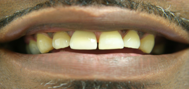 Fractured Tooth Repaired With A Crown 2 After 1