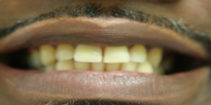 Fractured Tooth Repaired With A Crown 2 After 2