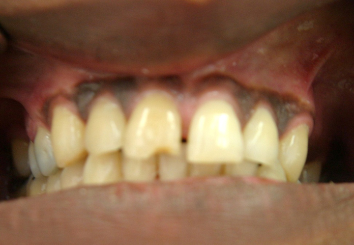 Fractured Tooth Repaired With A Crown 2 Before