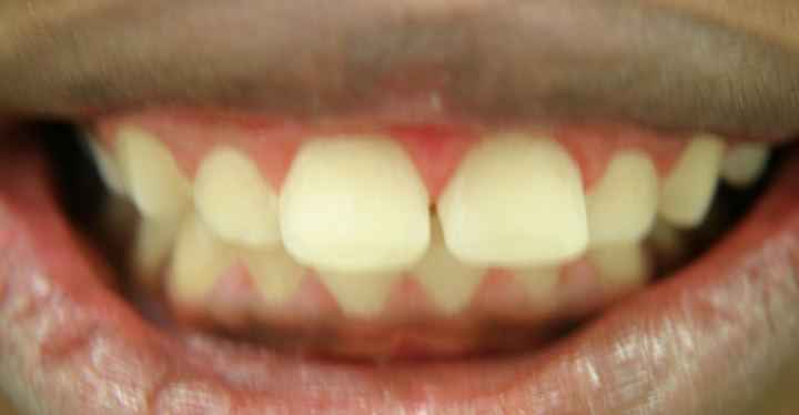Fractured Tooth Repaired With Bonding 1 After 2