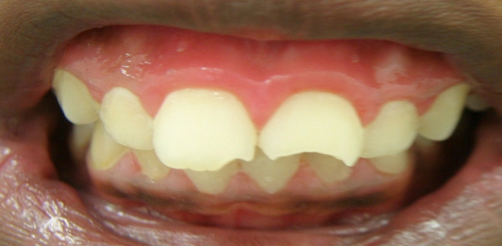Fractured Tooth Repaired With Bonding 1 Before 1