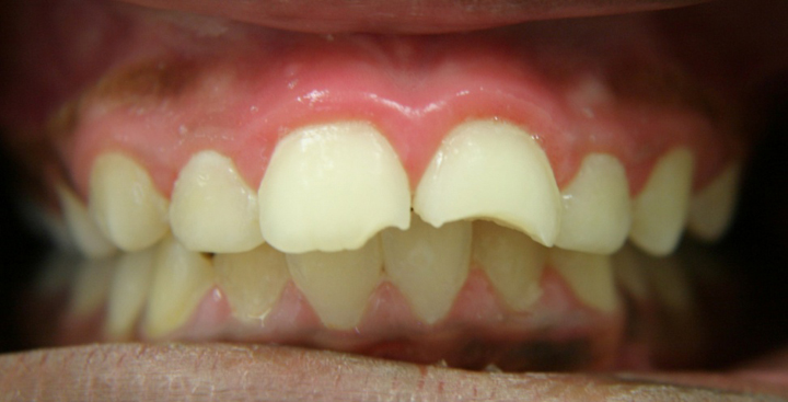 Fractured Tooth Repaired With Bonding 1 Before 2