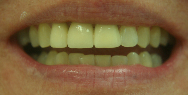 Front Tooth Replacement With A Bridge 1 After 1