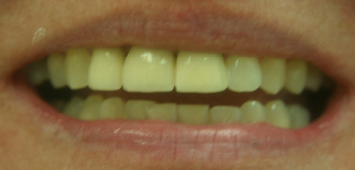 Front Tooth Replacement With A Bridge 1 After 2