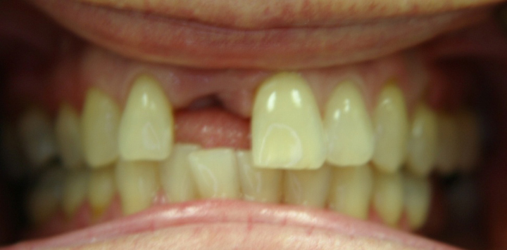 Front Tooth Replacement With A Bridge 1 Before