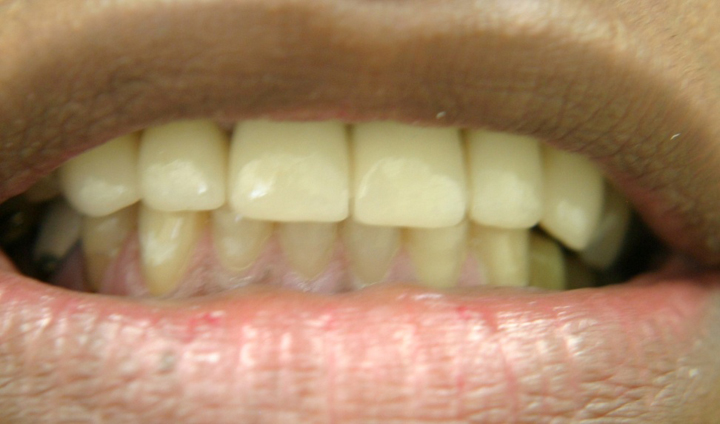 Missing Teeth Replacement With A Bridge 1 After