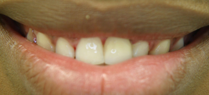 Missing Tooth Replacement 1 After
