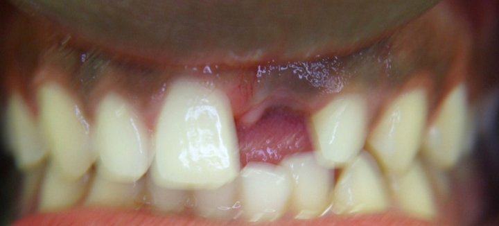 Missing Tooth Replacement 1 Before
