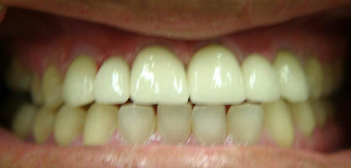 Smile Enhancement With Bridge 1 After 1