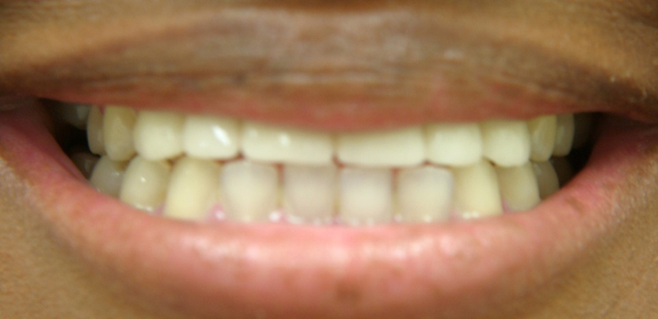 Smile Enhancement With Bridge 1 After 2