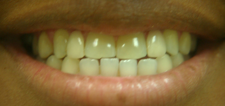 Smile Enhancement With Bridge 1 Before 1