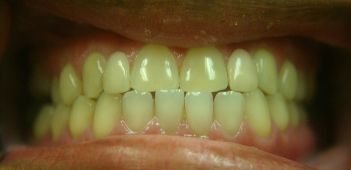 Smile Enhancement With Bridge 1 Before 2