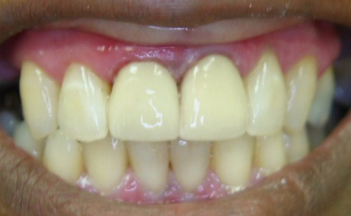 Smile Enhancement With Crowns 1 After
