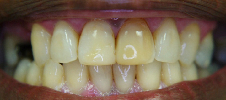 Smile Enhancement With Crowns 1 Before