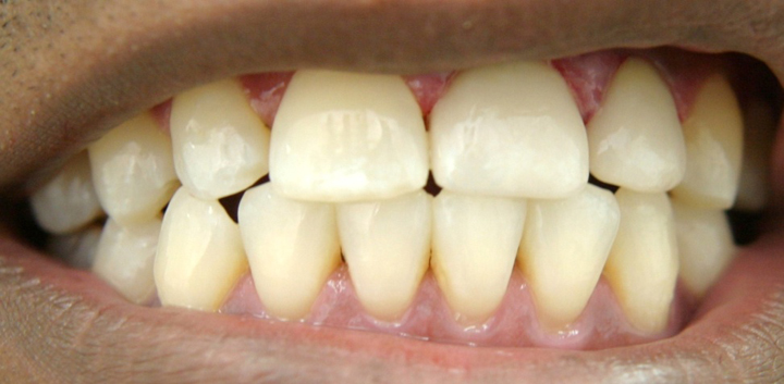 Smile Enhancement With Tooth Colored Crowns 1 After 1