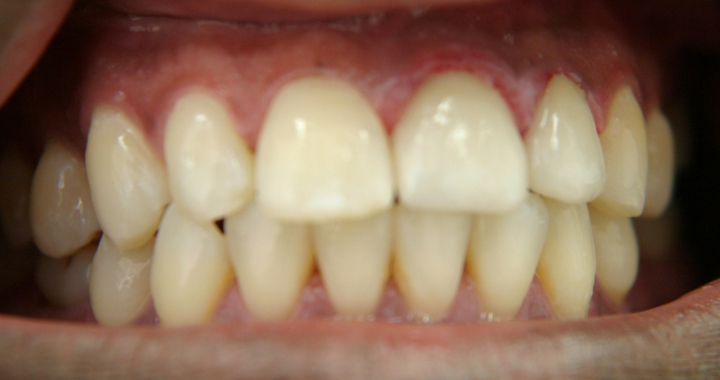 Smile Enhancement With Tooth Colored Crowns 1 After 2