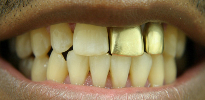 Smile Enhancement With Tooth Colored Crowns 1 Before 1
