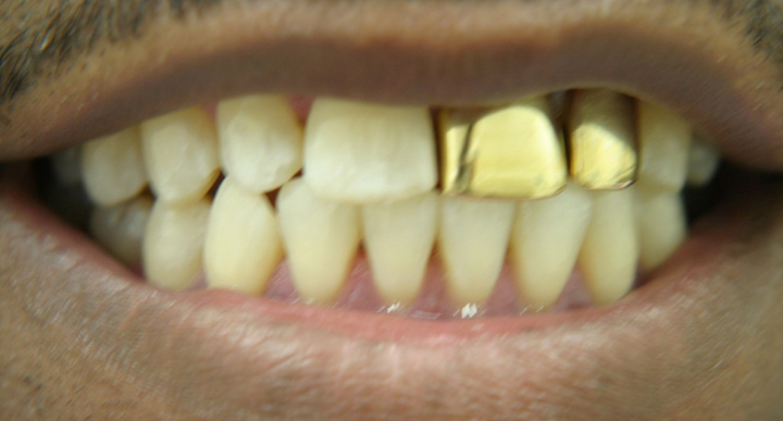 Smile Enhancement With Tooth Colored Crowns 1 Before 2