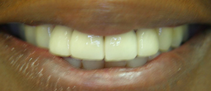 Smile Makeover With Several Crowns 1 After 1