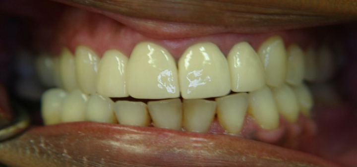 Smile Makeover With Several Crowns 1 After 2