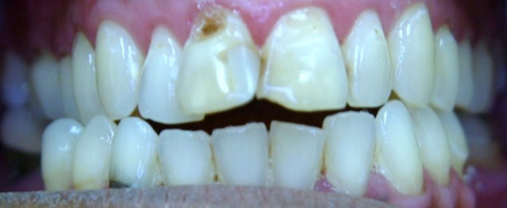 Smile Makeover With Several Crowns 1 Before